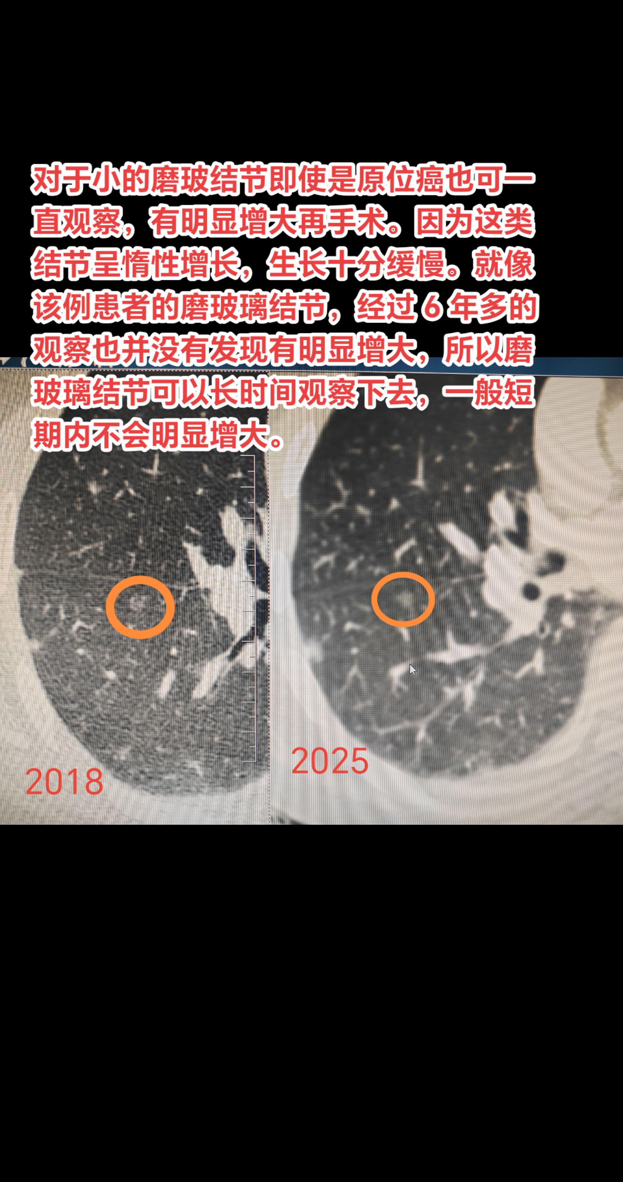 小磨玻璃结节会在短期内突然增大吗？对于小的磨玻结节即使是原位癌也可一直...