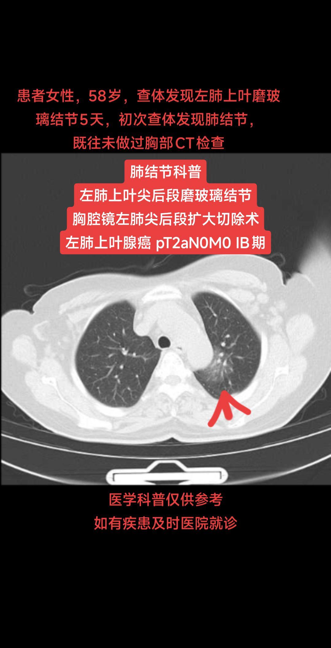 肺结节科普胸腔镜下左肺上叶尖后段扩大切除术肺门纵隔淋巴结清扫术  患者...