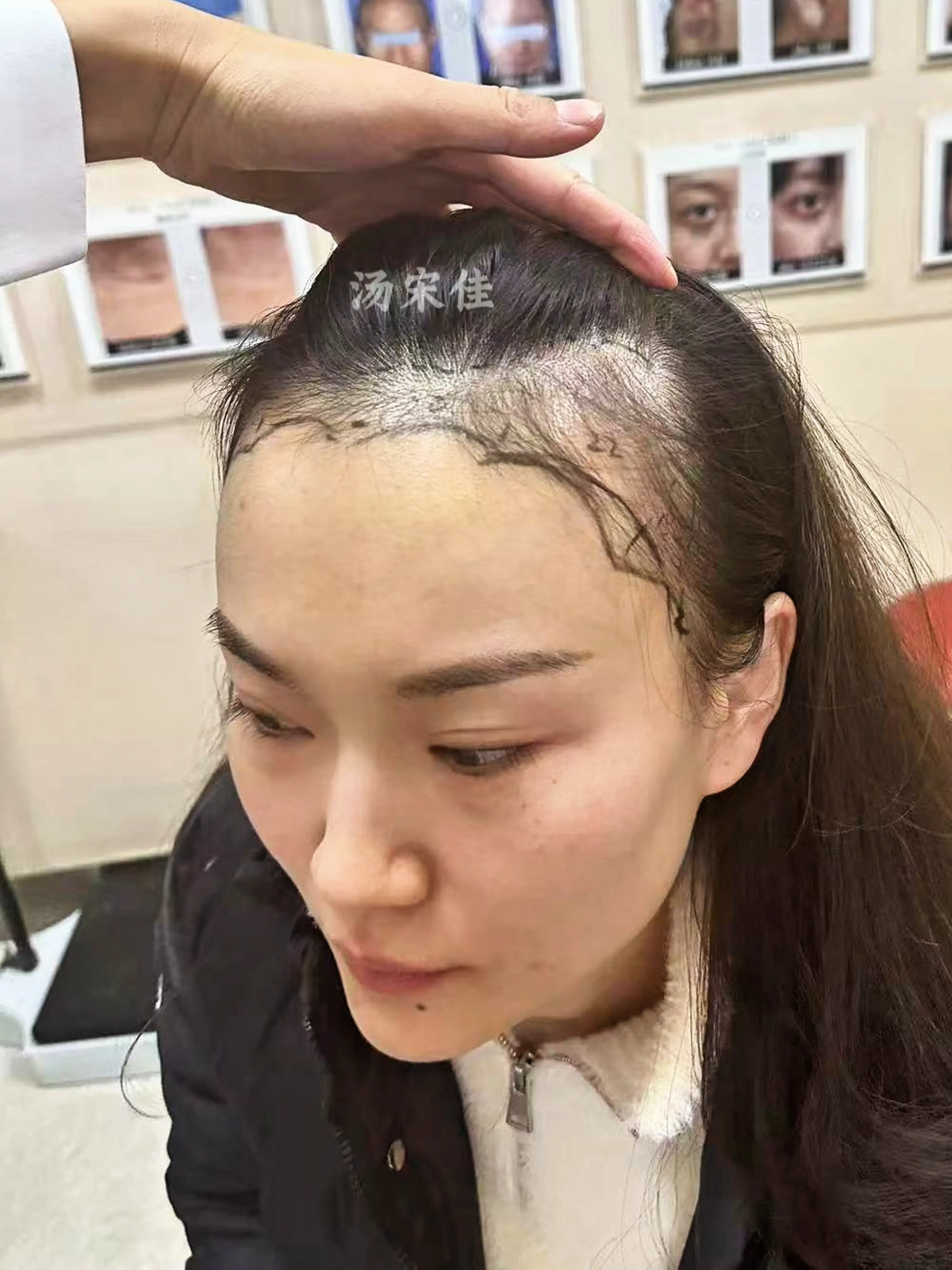 杭州植发🚄，真实记录。上海女教师专程到杭州植发🚄，真实记录植发际线九个月过程