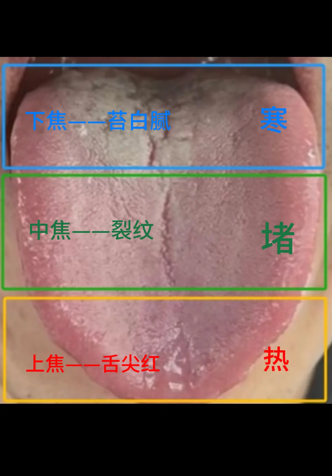 上热下寒，可能是中焦淤堵造成的。表现：下半身凉，上半身热，尤其脚冰凉...