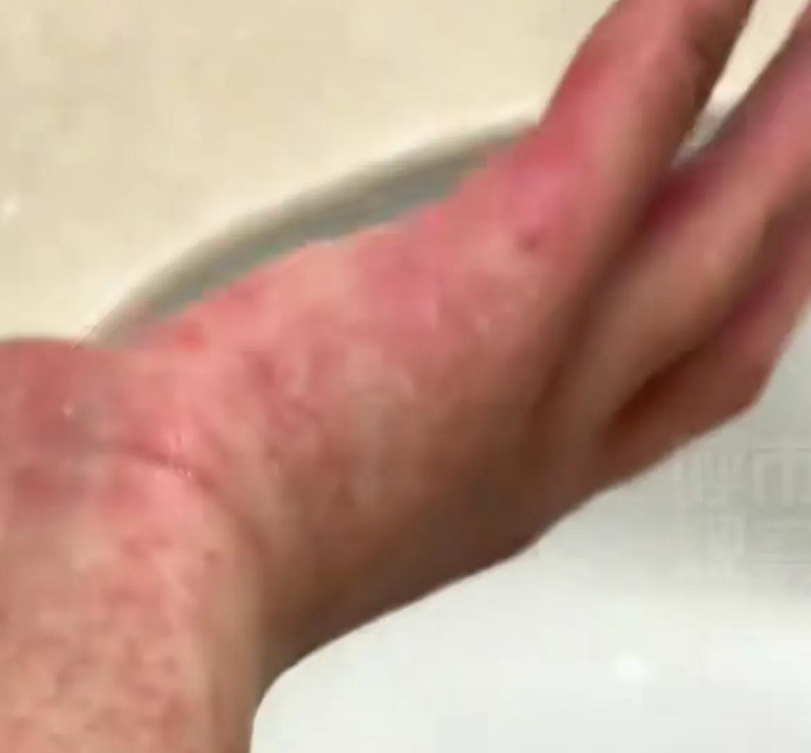 呼和浩特已有登革热病毒 病例报告，疾控中心重要提醒：出行高发地区做好防蚊措施，返