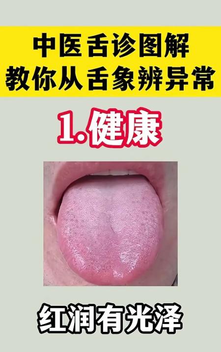 6 种常见舌象解析，教你看懂健康信号