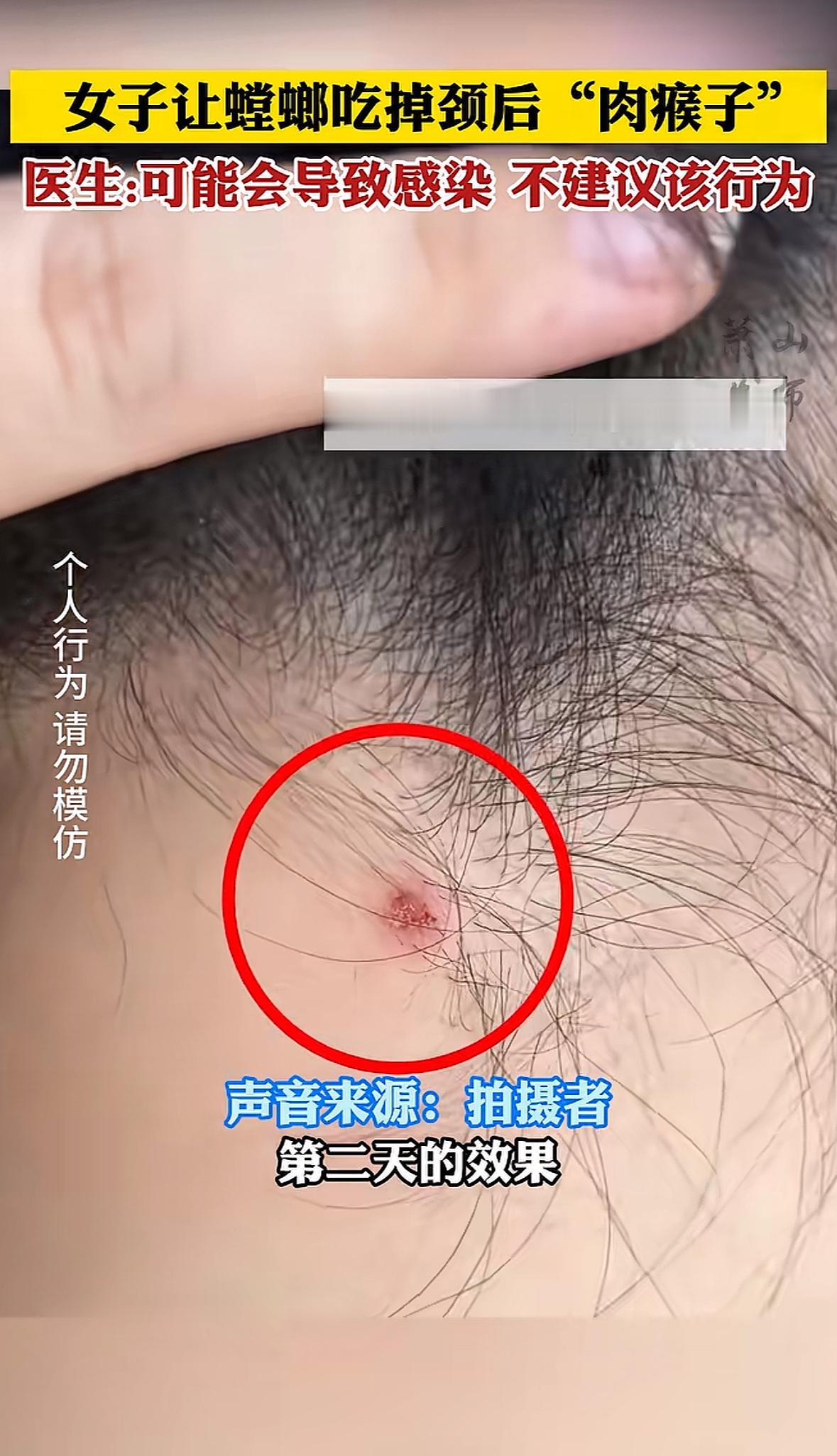 女子让螳螂帮忙吃肉瘊子先不说有没有效果吧，光是看着就鸡皮疙瘩起来了感觉特别痛啊我