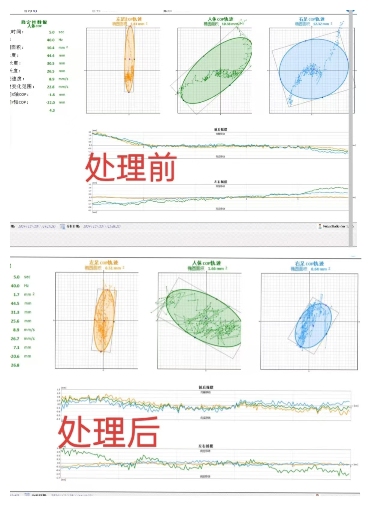 锐博康复  再给大家看个数字化的工具[酷]北京华腾店这位会员右侧有明显的腰背疼痛