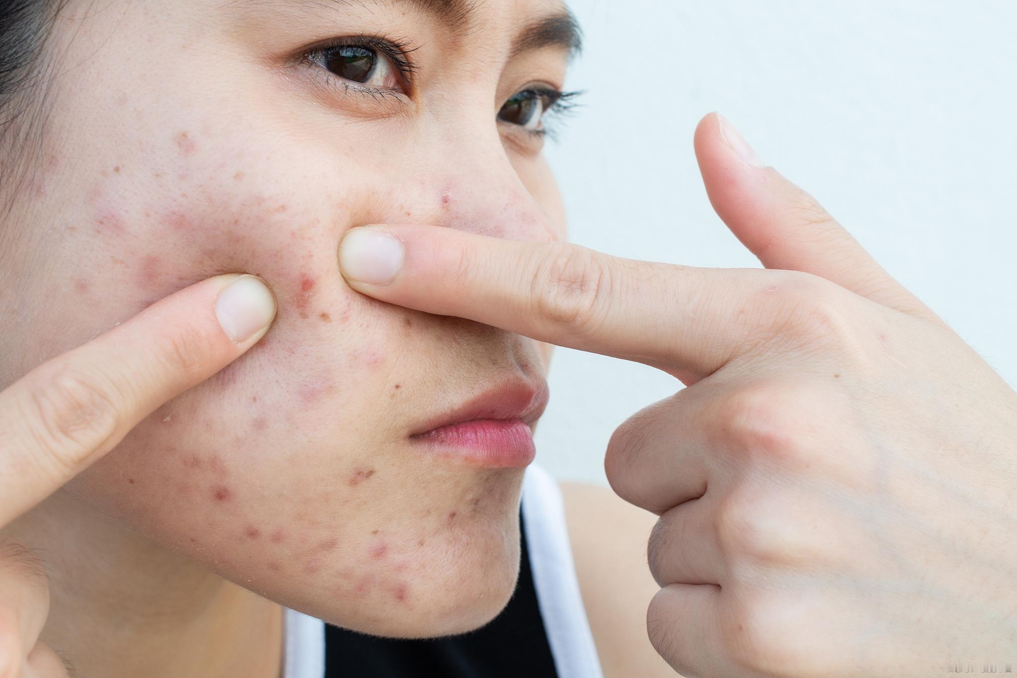 深夜话题：你脸上会长痘痘吗？有哪些好的处理治疗方法？ 这种粉刺痤疮到底要不要用手