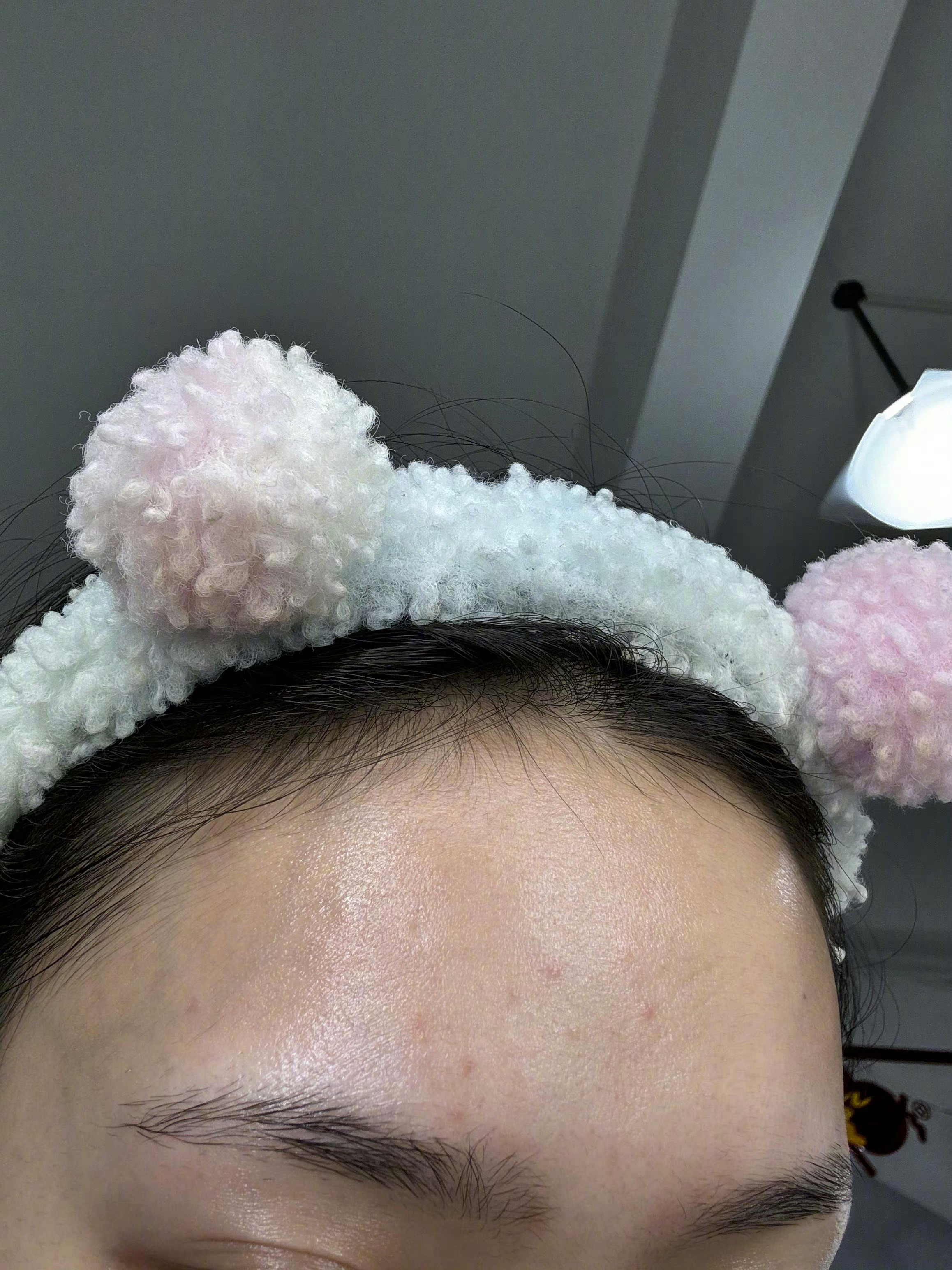 #林允纯素颜状态#林允发博晒出素颜照！说为了闭口第一次刷酸 连刷了三天第二天开始