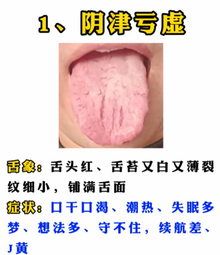 看舌象辨肾虚：4 种类型，你属于哪一种？