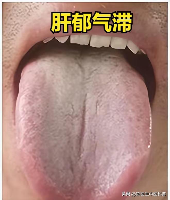 肝郁气滞证在舌苔上的典型表现为舌苔薄白，部分病情迁延或兼有湿邪者，可能出现舌苔白