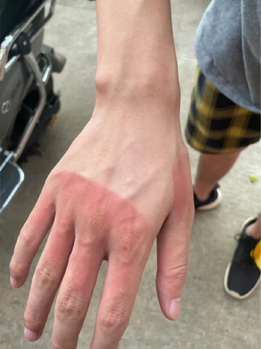 夏天运动不防晒的人都怎么样了 真心劝一句！夏天运动不防晒真的会吃大亏，皮肤红痒脱
