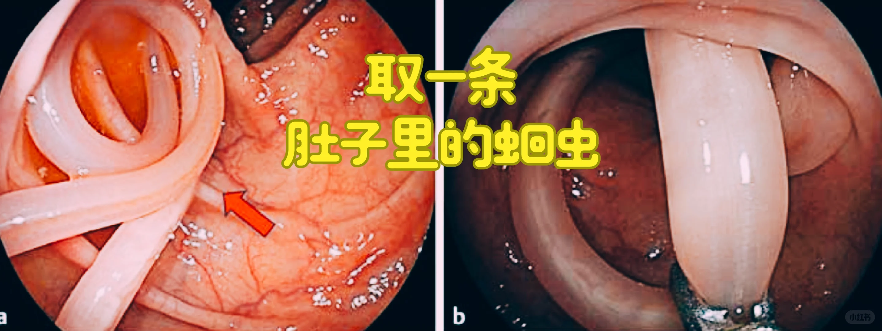 取一条肚子里的蛔虫