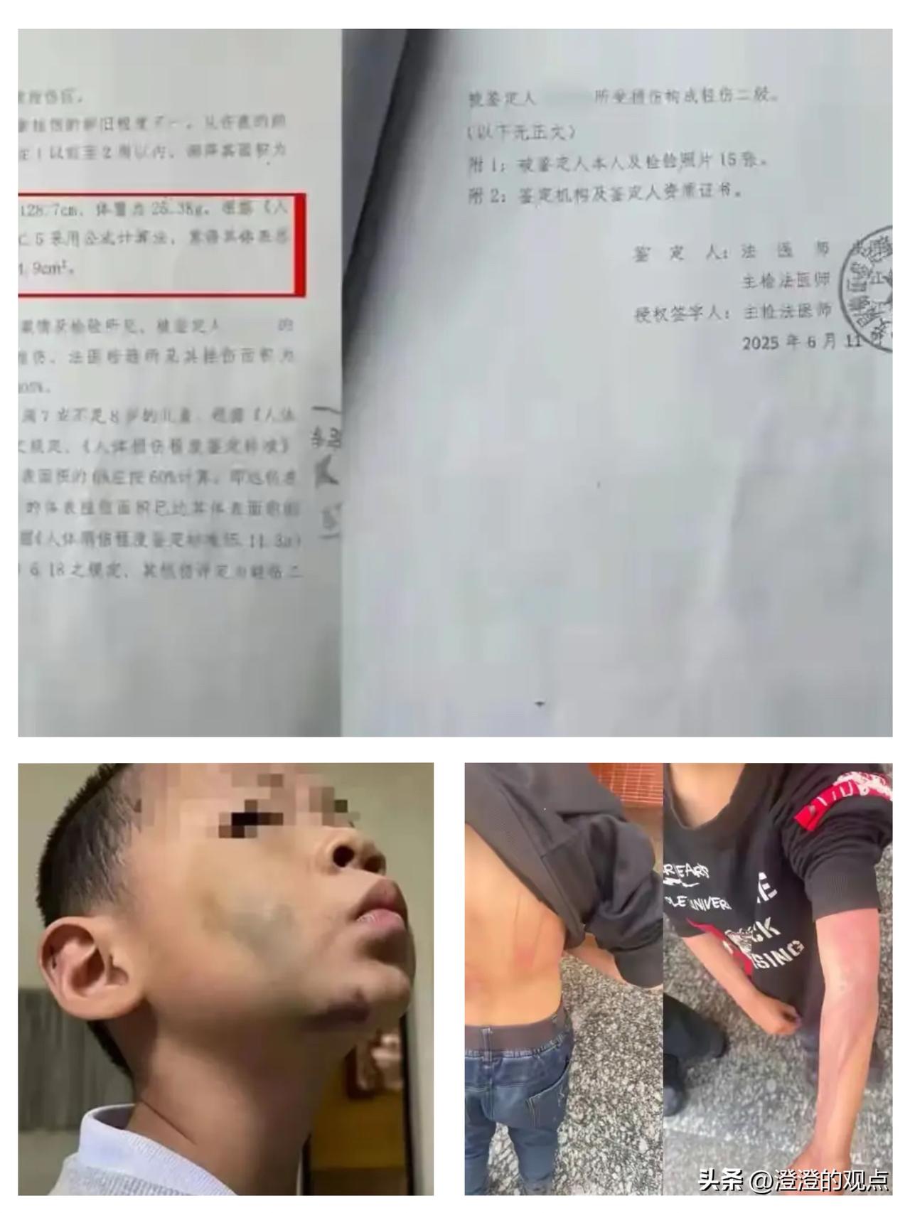 湖南武冈这事儿真是震碎三观，

那个后妈居然还是烧伤科的护士！

正因为懂行，她