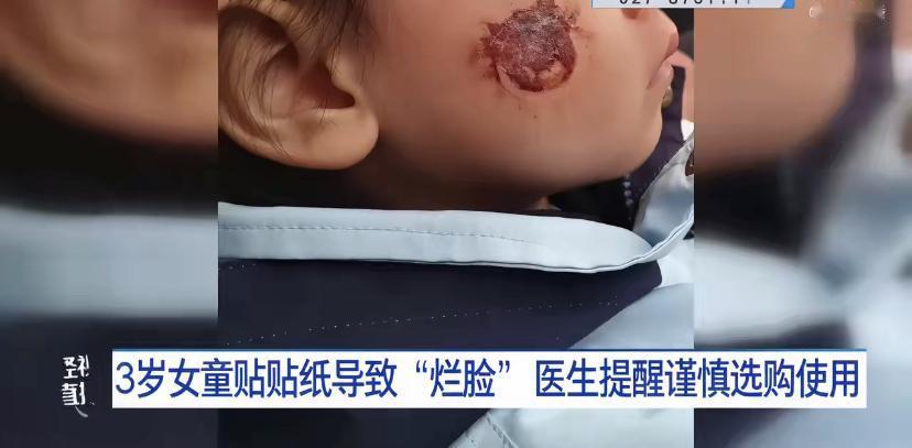 最近有个事特别让人心疼。湖南一个三岁的小姑娘，在幼儿园过完节，脸上就出问题了一右