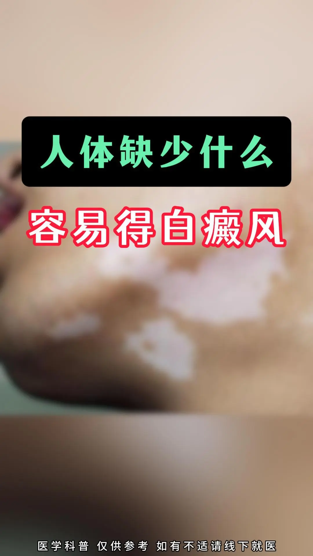 身体缺乏某些微量元素是白癜风发病的一个重要因素。哪些微量元素的缺乏容易...