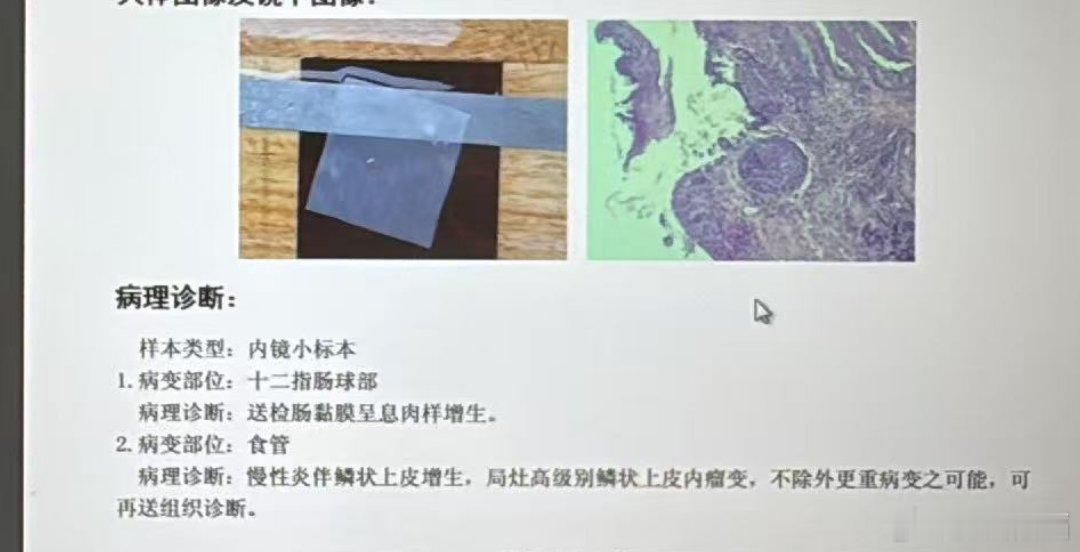 食管早癌发现率还是可以的，NBI扫过去，茶褐色，边界不规则，目前能取活检，最后确