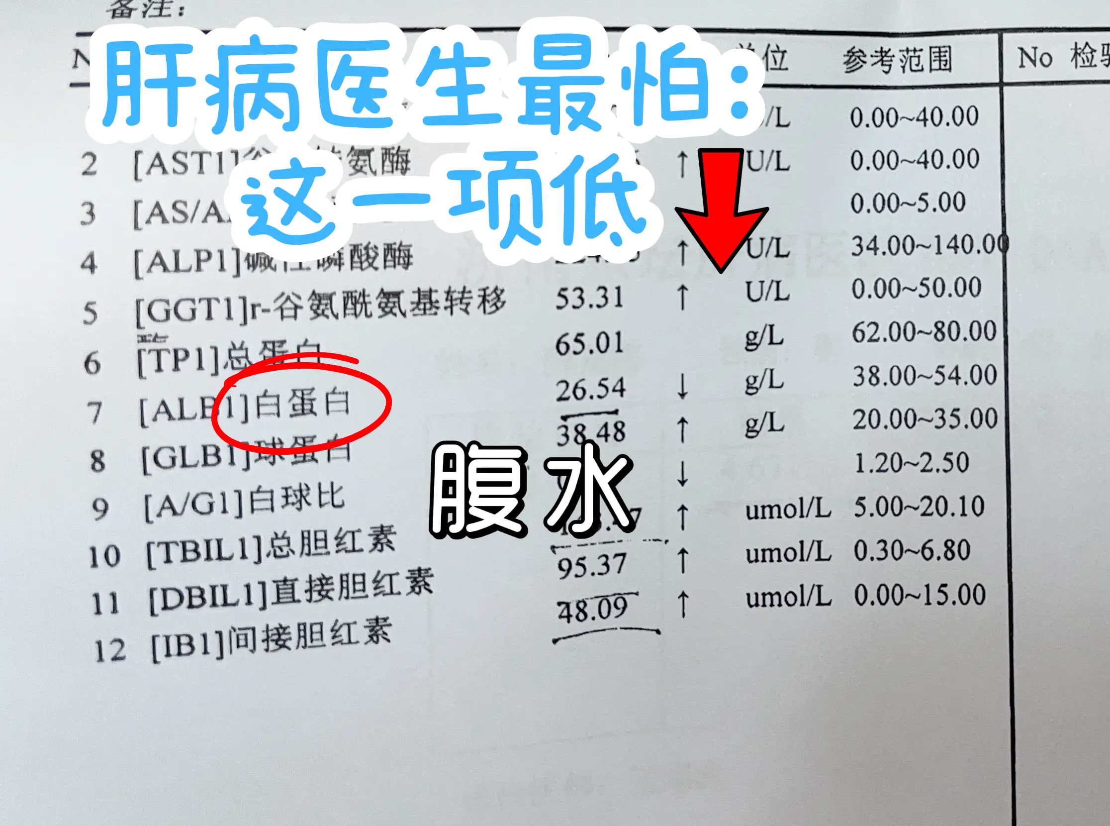 肝病医生最怕肝功能上，这一项降低！ 这是一位山东潍坊的肝病患者的检查单...