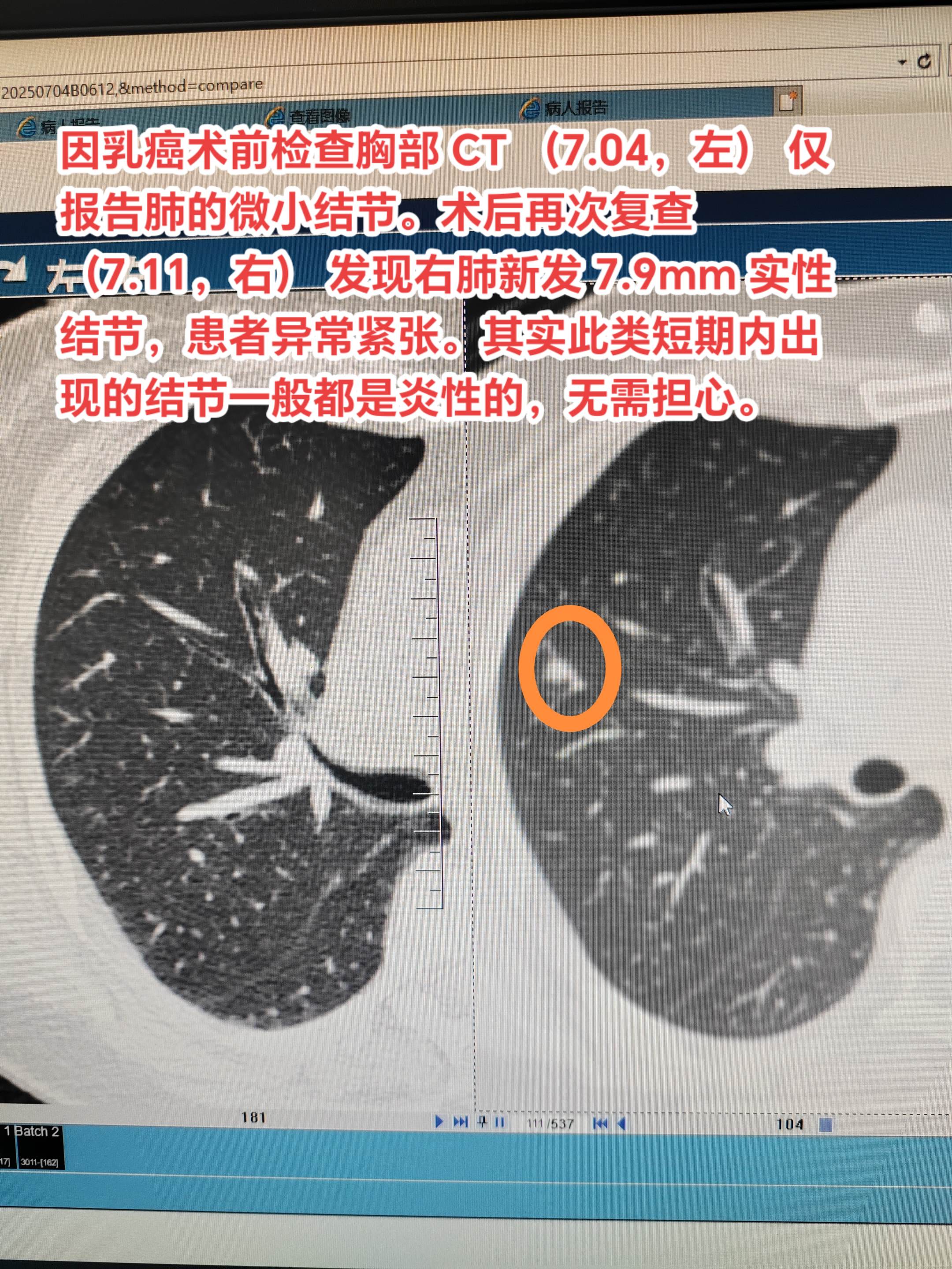 短期内出现的大的结节一般都是炎性的结节。因乳癌术前检查胸部 CT （7...