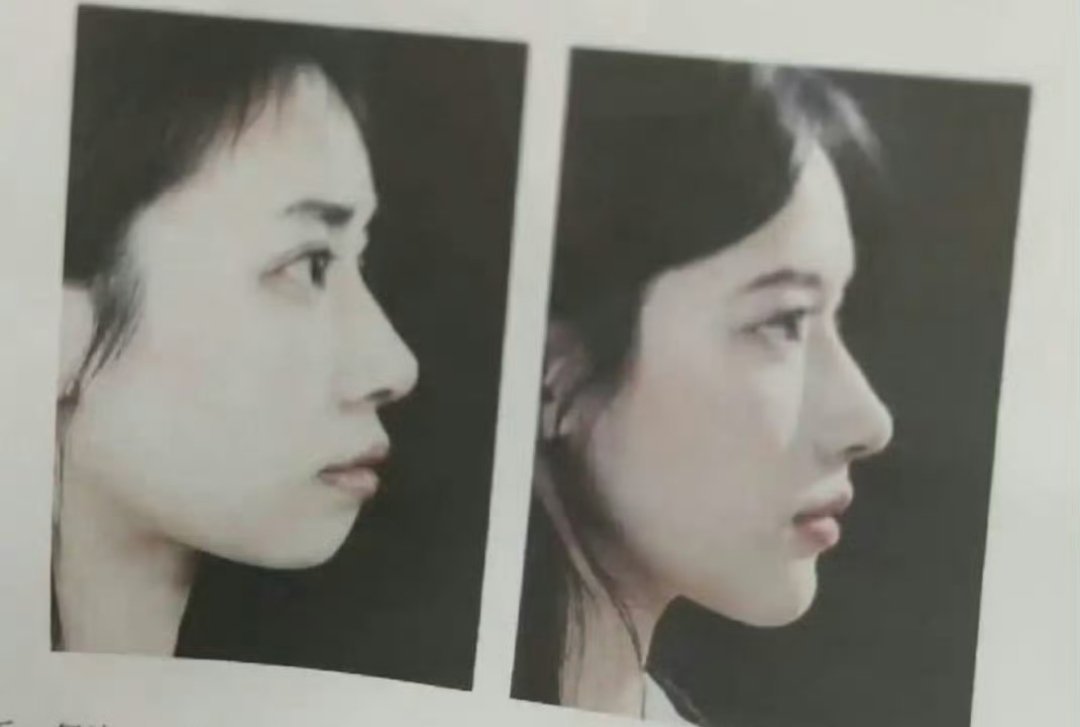 做牙前后对比，这真的是一个人吗？ 