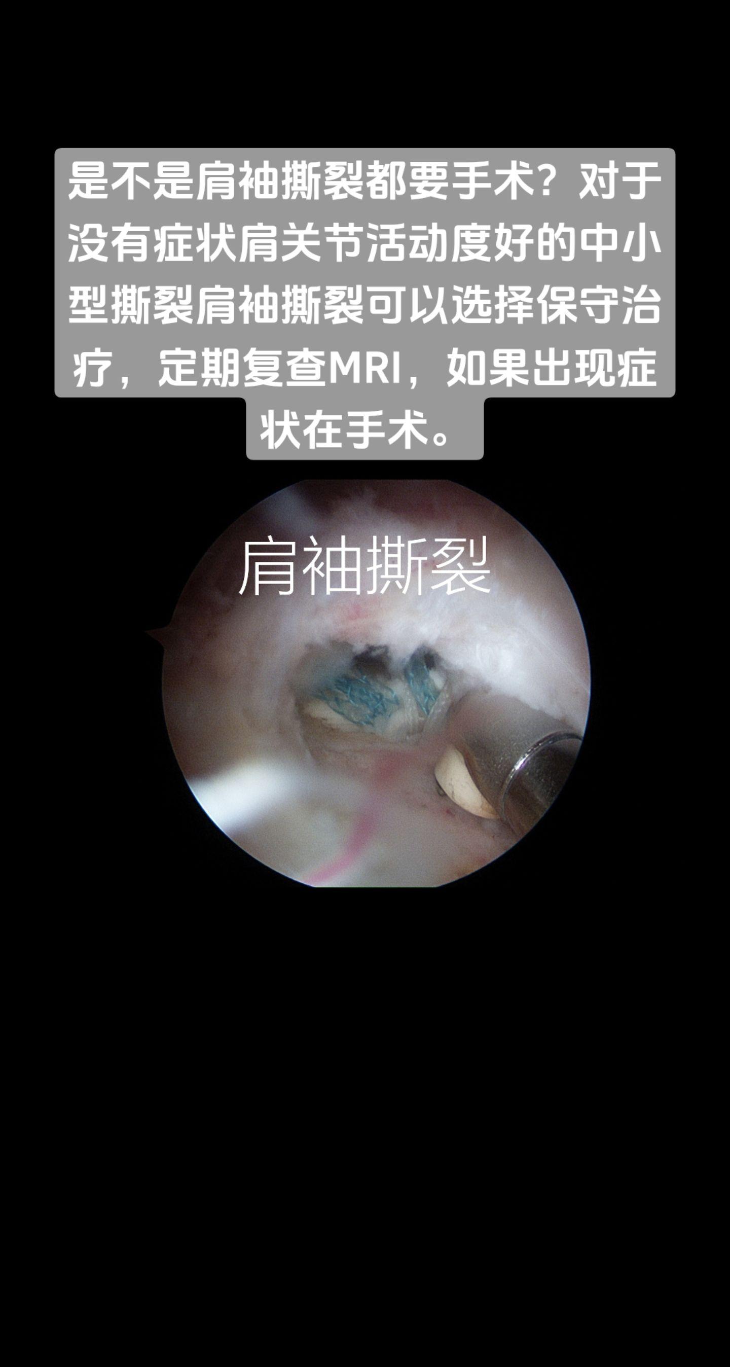 肩袖撕裂一定要手术吗？