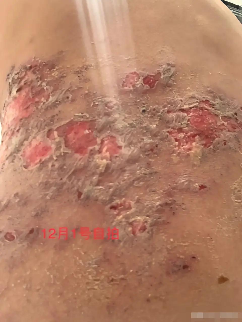 四川第一，广西第二。
2025年，美国艾滋病病人130万。
国内120万，大约平