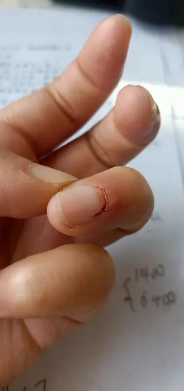 手指断了三个月还肿，原因还挺多。首先可能是骨折没完全愈合，毕竟手指骨头小，愈合时