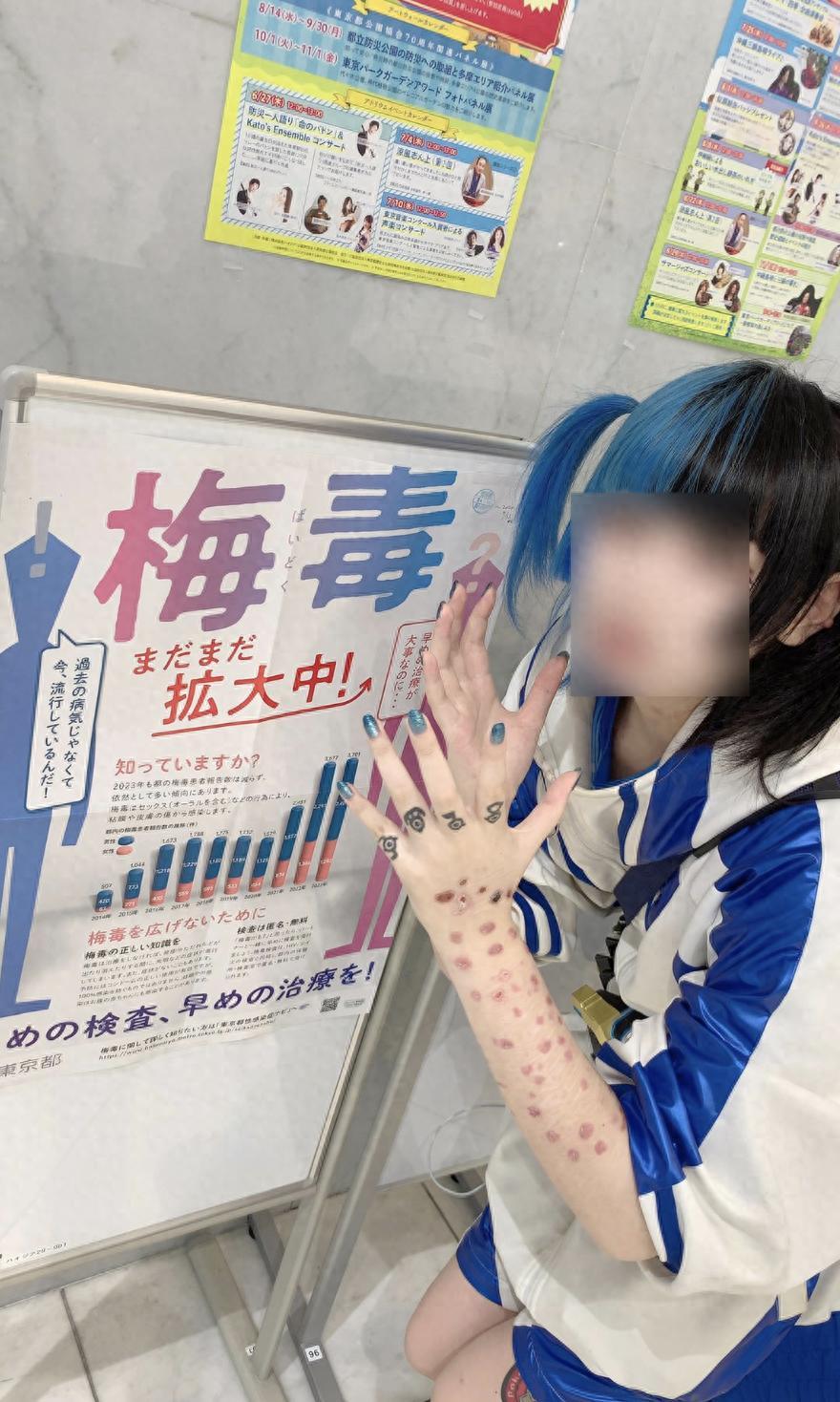 奇葩！日本年轻人热衷晒梅毒疤？感染人数连年暴增引担忧！

最近有个让人看不懂的新