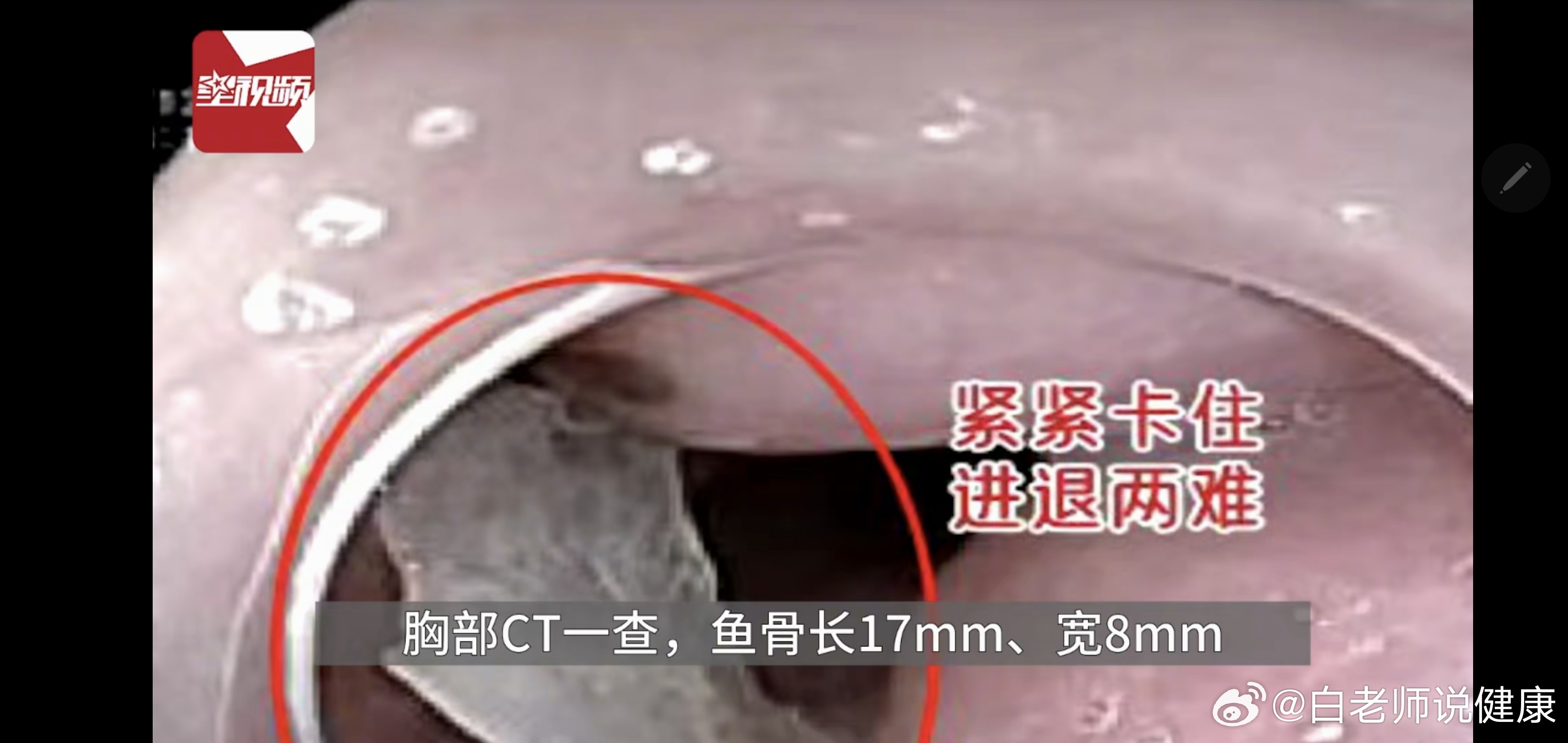 女子被卡喉，硬撑18小时后命悬一线，医生巧用1个避孕套救了她，网友：太神奇了！一