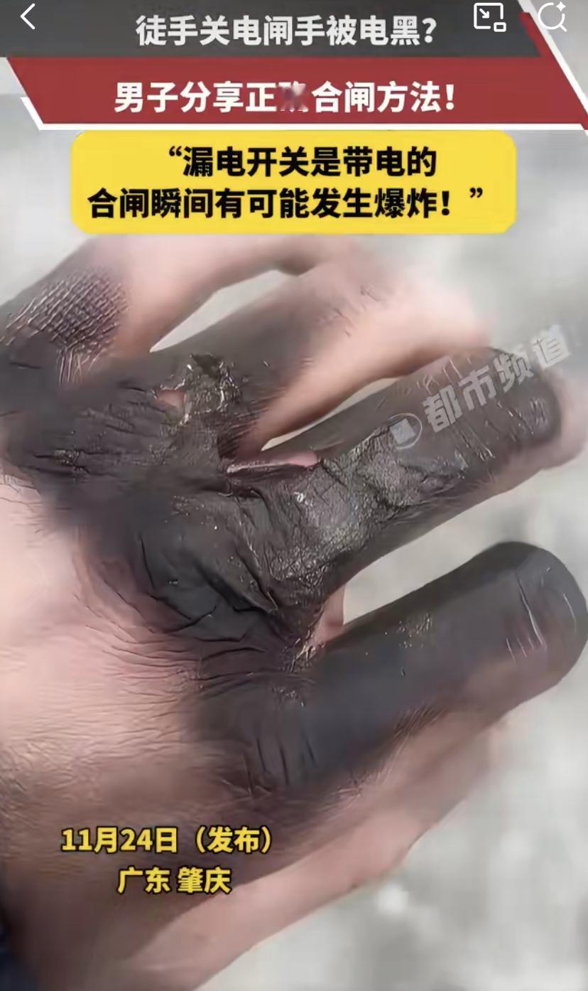 徒手关电闸太吓人!广东一哥们儿手被炸得焦黑，这个动作你可能也常做!
你说吓人不?