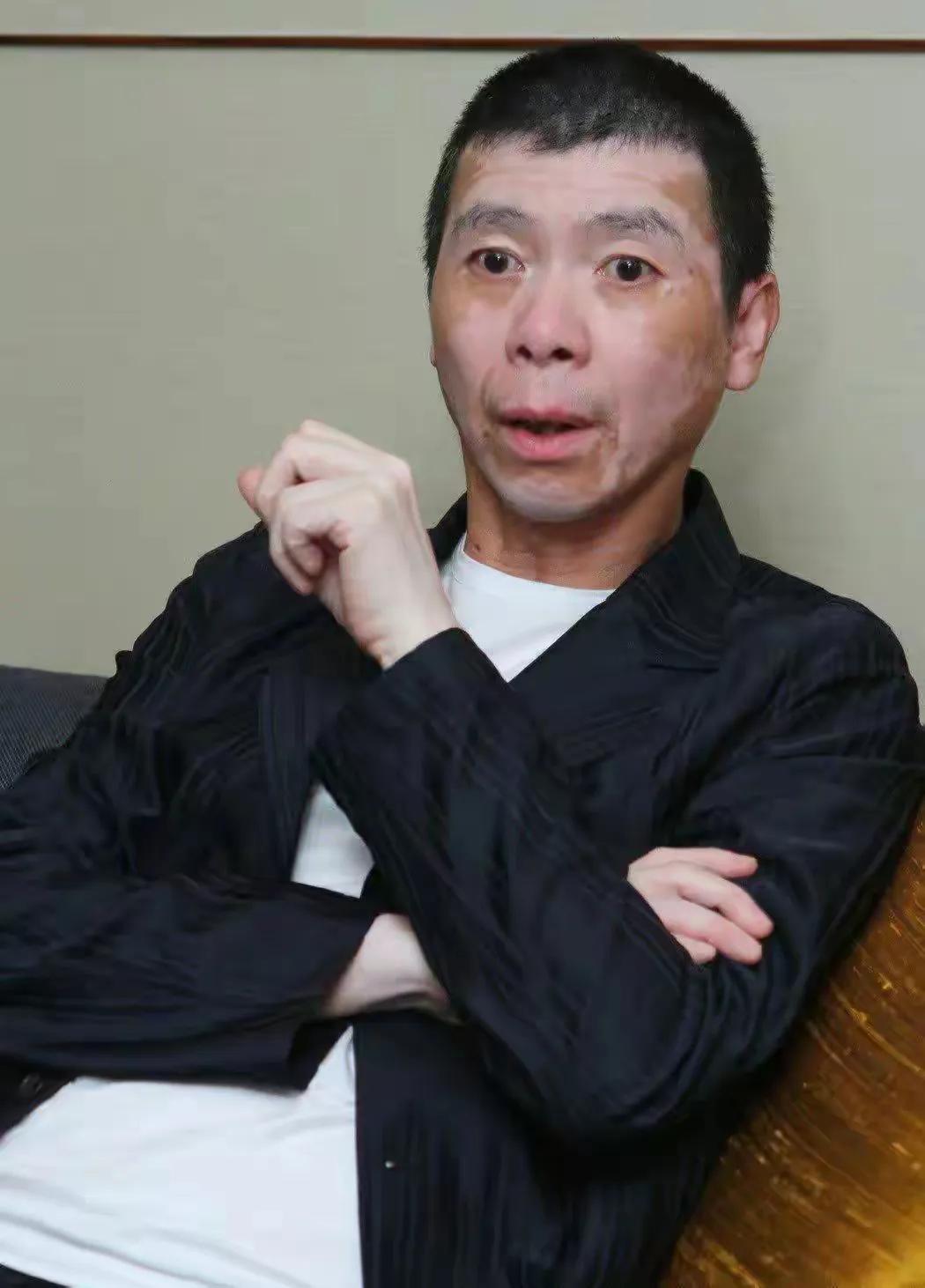 冯小刚，脸上白癜风神奇的好了！

冯小刚脸上有白癜风，几乎是他的招牌。但是最近出