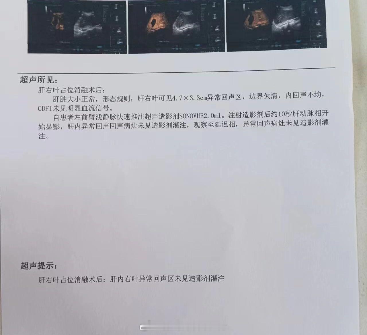 肿瘤手术后遵医嘱复查有多重要？38岁的男子，这是做第4次肝癌手术了。第1次是8年