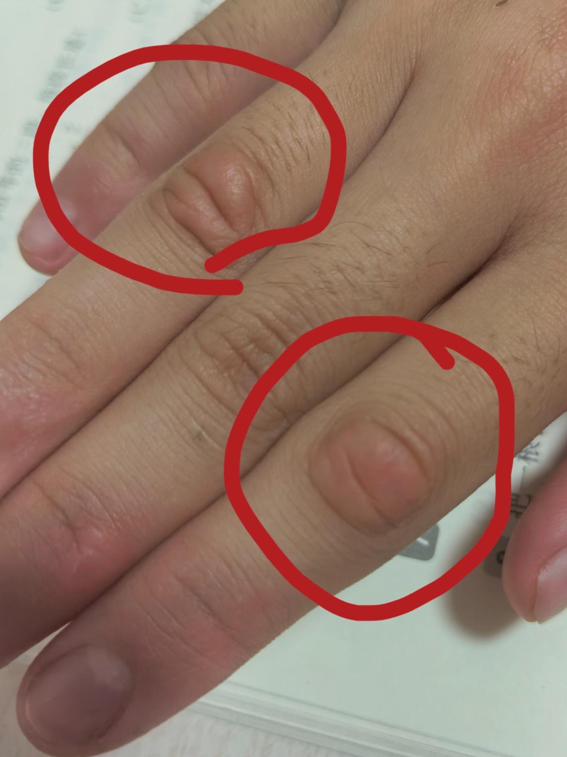 小孩手指关节这是怎么了？

看着红红肿肿的，

有没有人知道？

国庆放假回老家