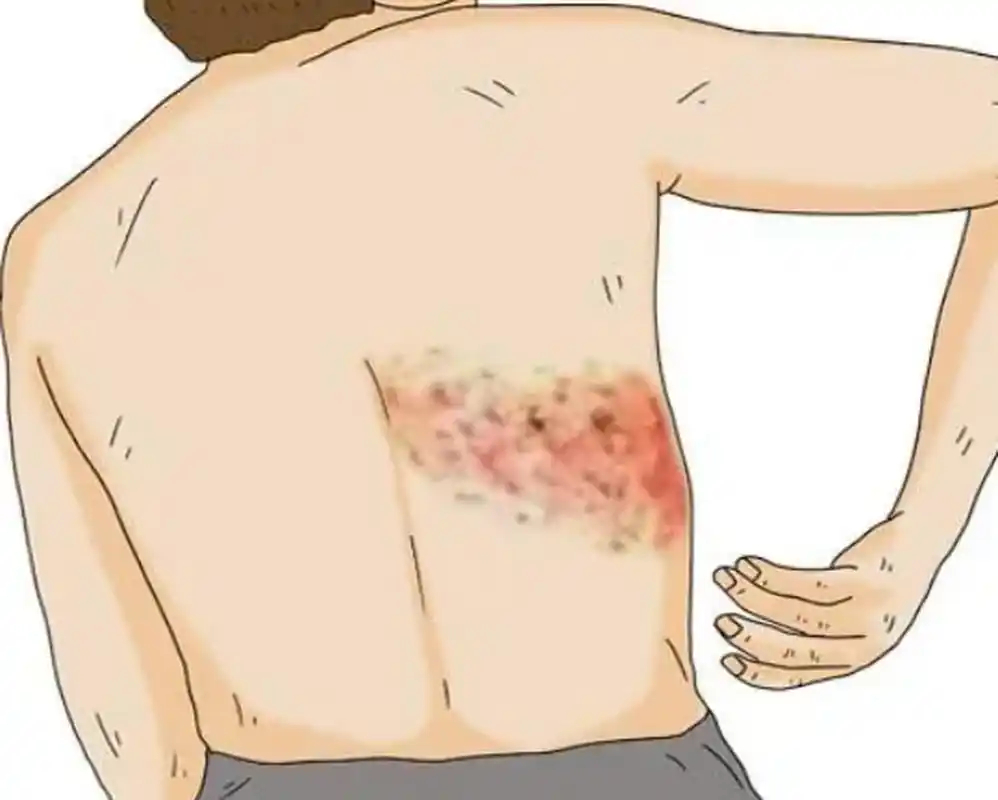 缠腰龙容易缠上糖尿病糖尿病患者免疫屏障薄弱，更易被带状疱疹病毒侵袭，且发病时疼痛