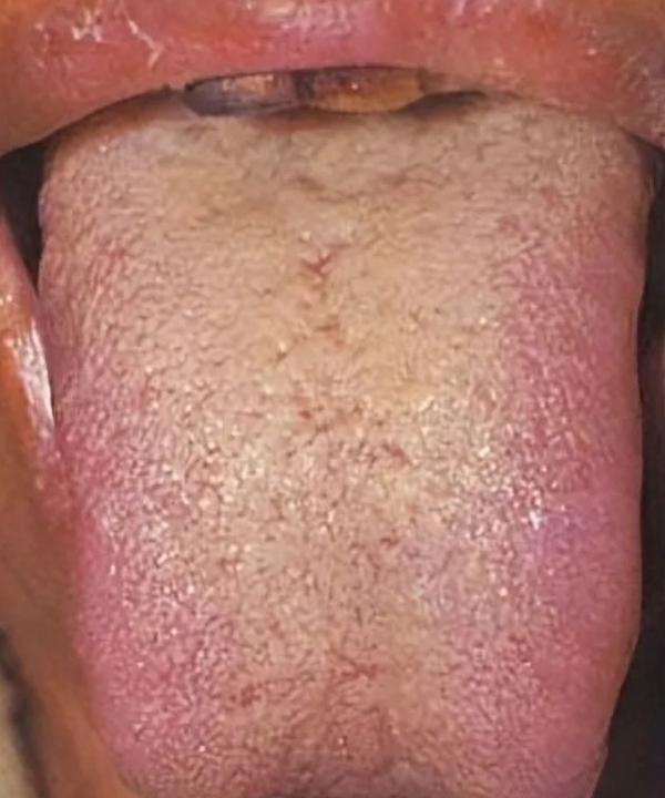 胃里总隐痛反酸，吃胃药也反复？先看舌头！这种舌象，说明是脾胃湿热在捣乱！
大家好