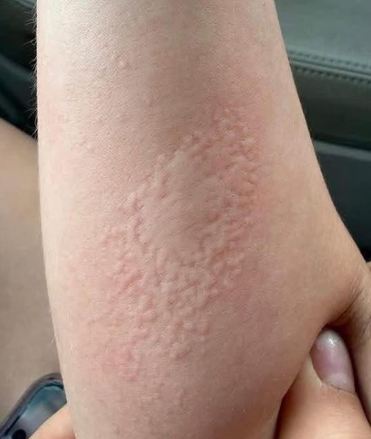 一名年轻女孩与认识已久的外国网友奔现共度一夜后，清晨醒来惊见手臂红疹密布，灼痛刺