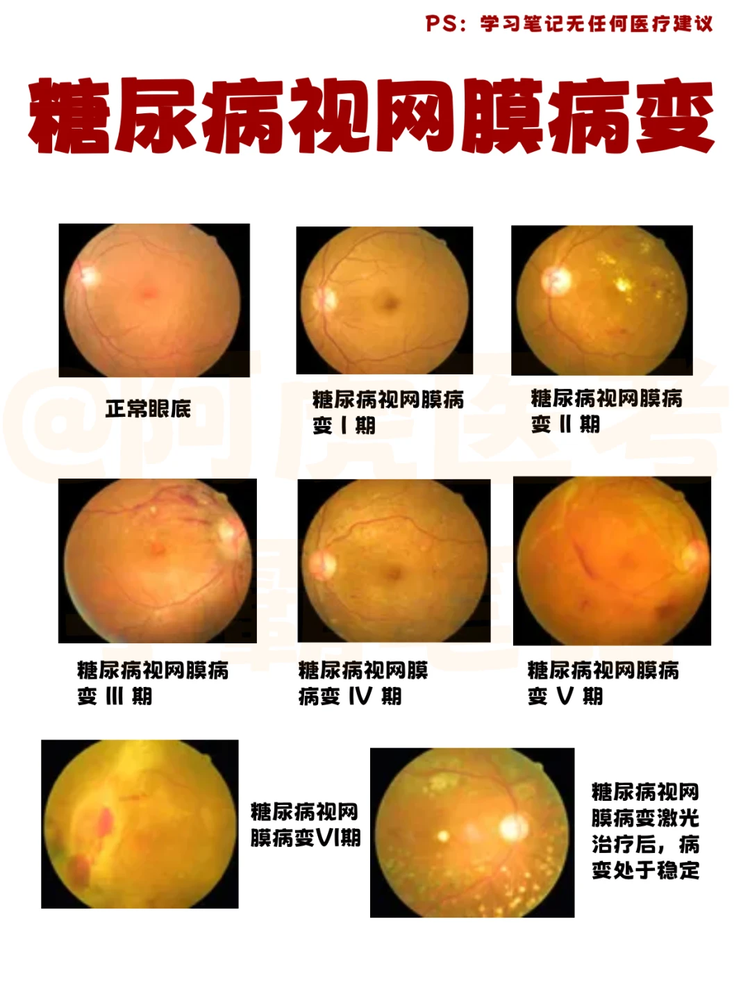 阿虎医考笔记：读懂糖尿病视网膜病变分期