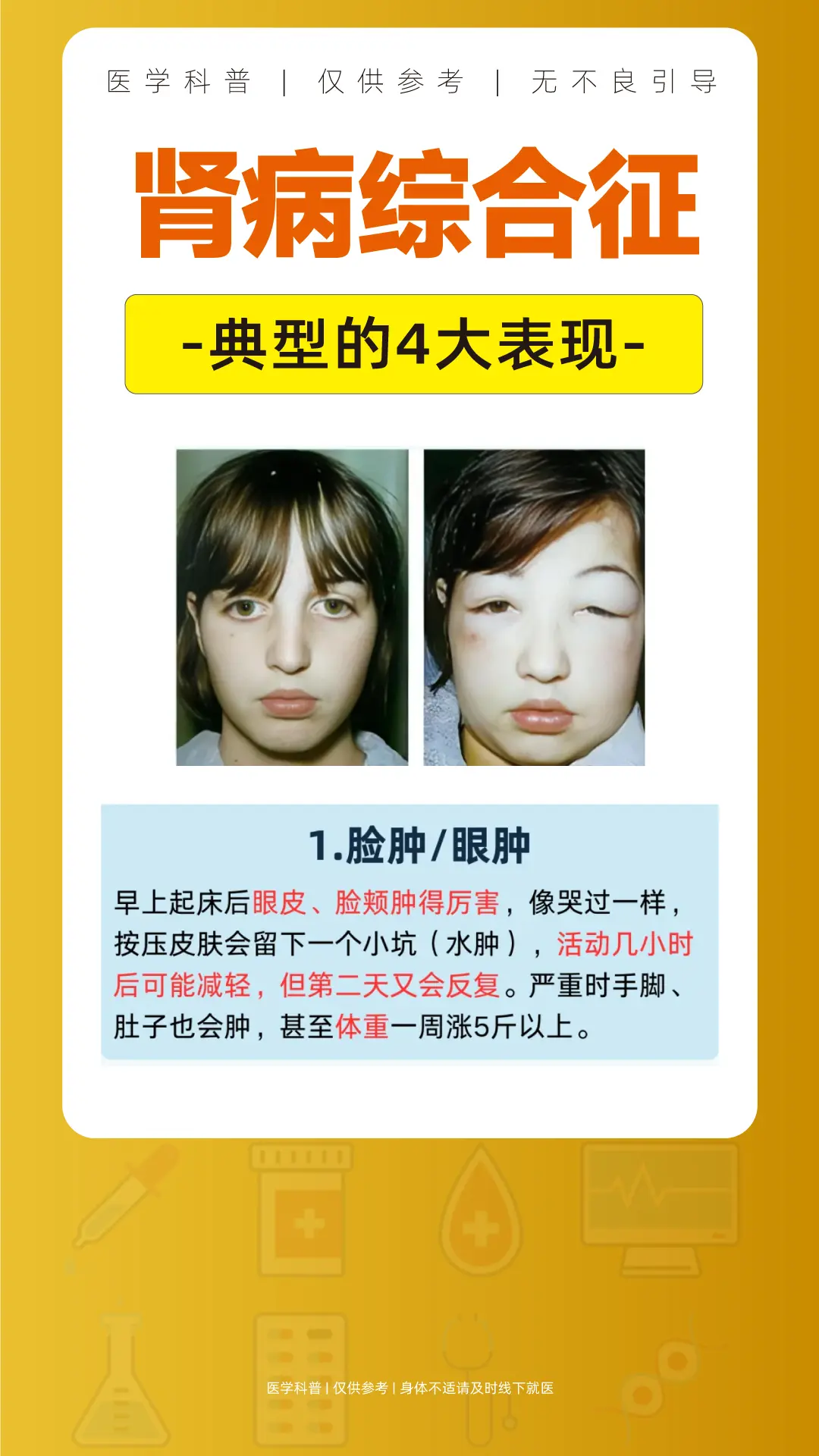 肾病综合征。