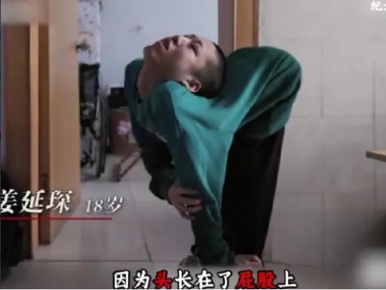 奇迹！山东德州的姜延琛，生来便被命运按下暂停键——16岁的他因罕见病症，脑袋近乎