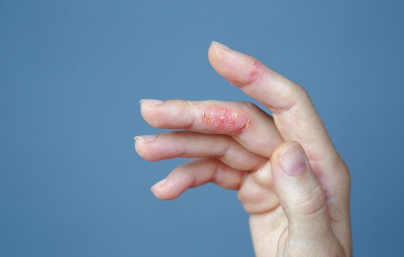 这种皮肤病常被误以为是脚气，很痒很尴尬！还容易反复发作

人脚底一痒，就下意识觉