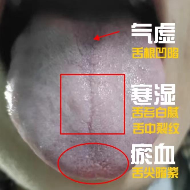 又有寒湿又有瘀，难怪软短难坚还无力，我来教你如何祛湿通瘀，助你重回巅峰！
有一位