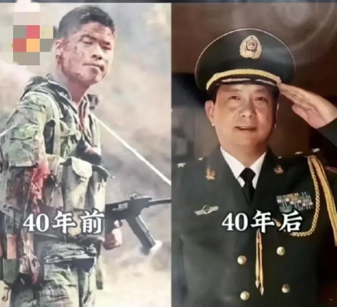1984年老山战役，一名新兵手臂被炸烂，他毅然用匕首斩断连着骨头的断臂，随后竟扛