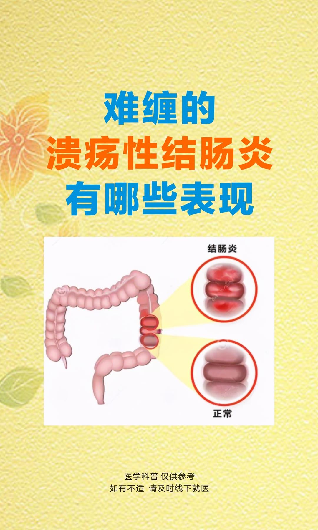 医学科普 溃疡性结肠炎 中医顾思臻 顾思臻
