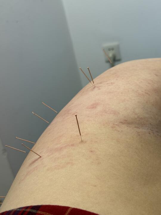 带状疱疹的第5天，火灸一下