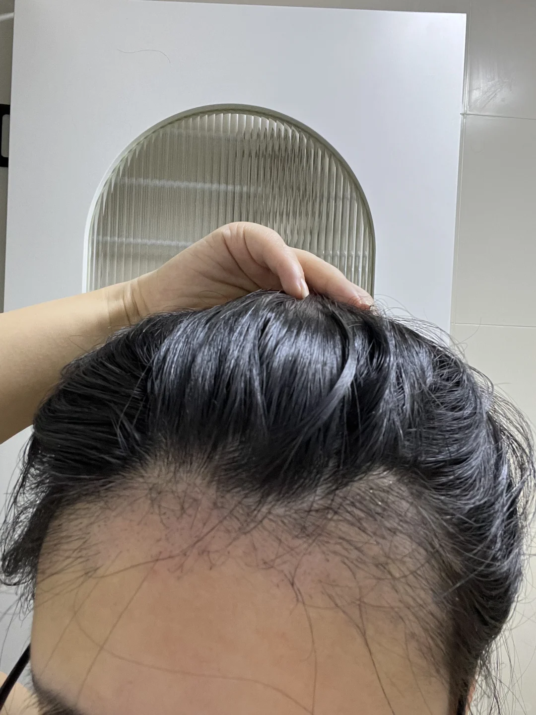 植发失败了吗
