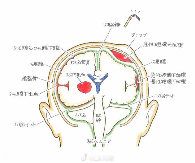 #急性硬膜下血肿# 急性硬膜下血肿属于脑出血的一种，大多数是外伤所致。从我们的头
