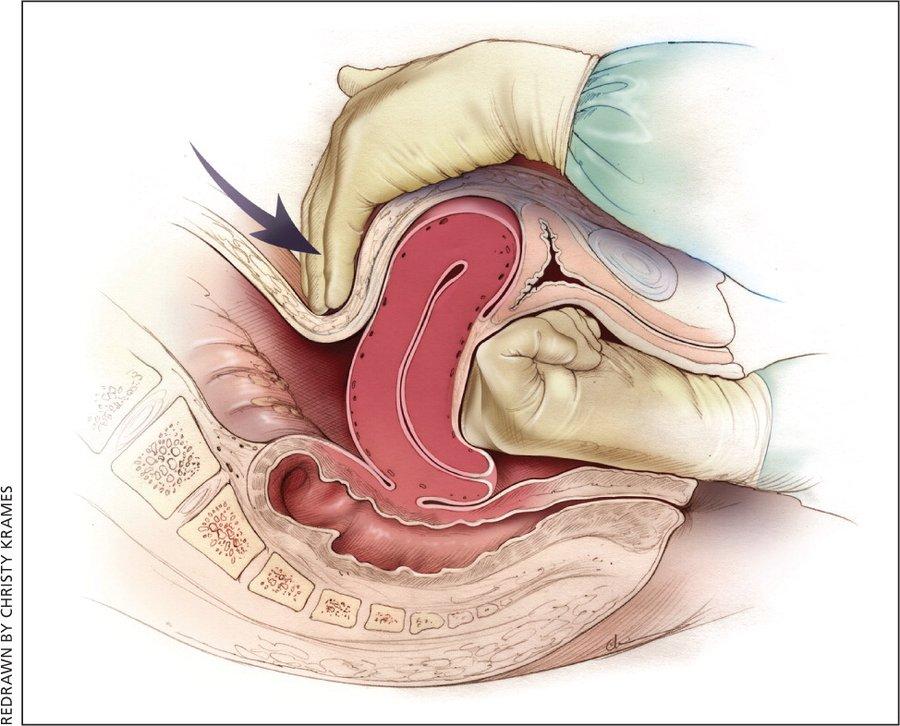 产后出血是导致孕产妇死亡的首要原因。
　　成年人体内含有大约5升血液，在怀孕后期