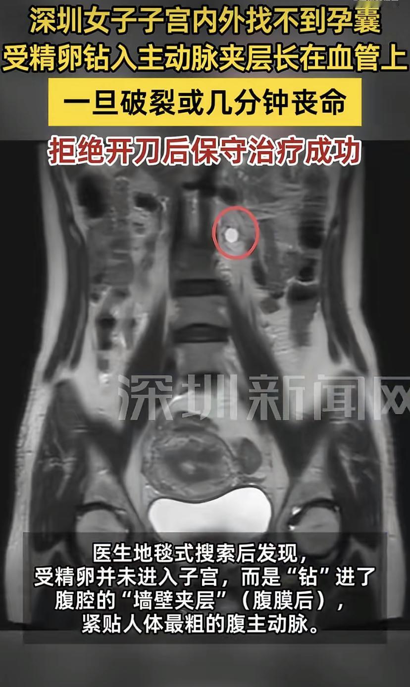 太离奇了!深圳王女士用验孕棒测出怀孕，结果B超，CT愣是找不到孕囊。医生都快把仪