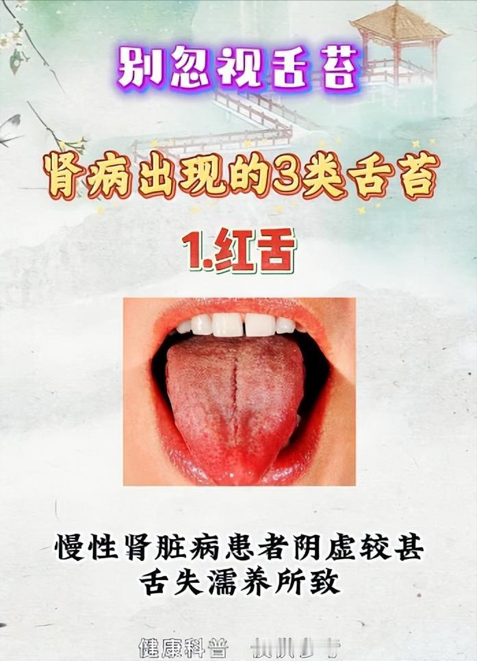 别忽视舌苔，肾病常常会出现的3类舌苔~
