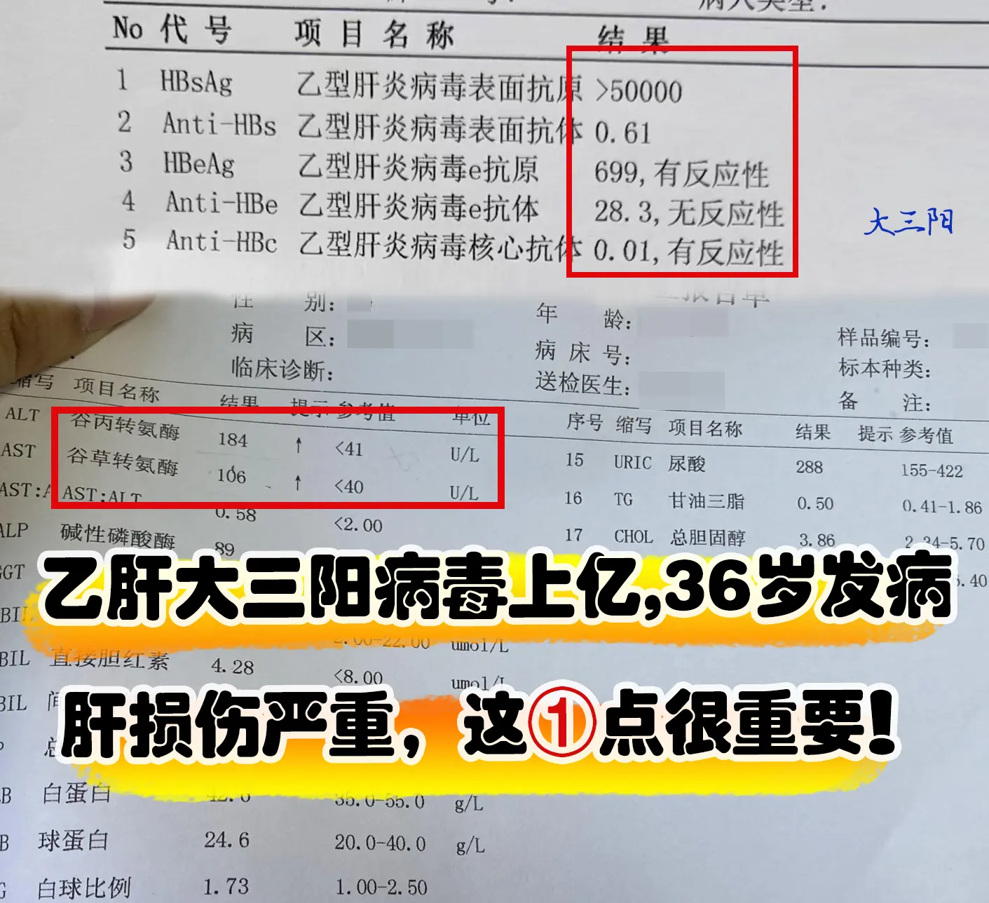 乙肝大三阳病毒上亿，36岁发病，肝损伤严重，这一点要警惕！  这位聊城...