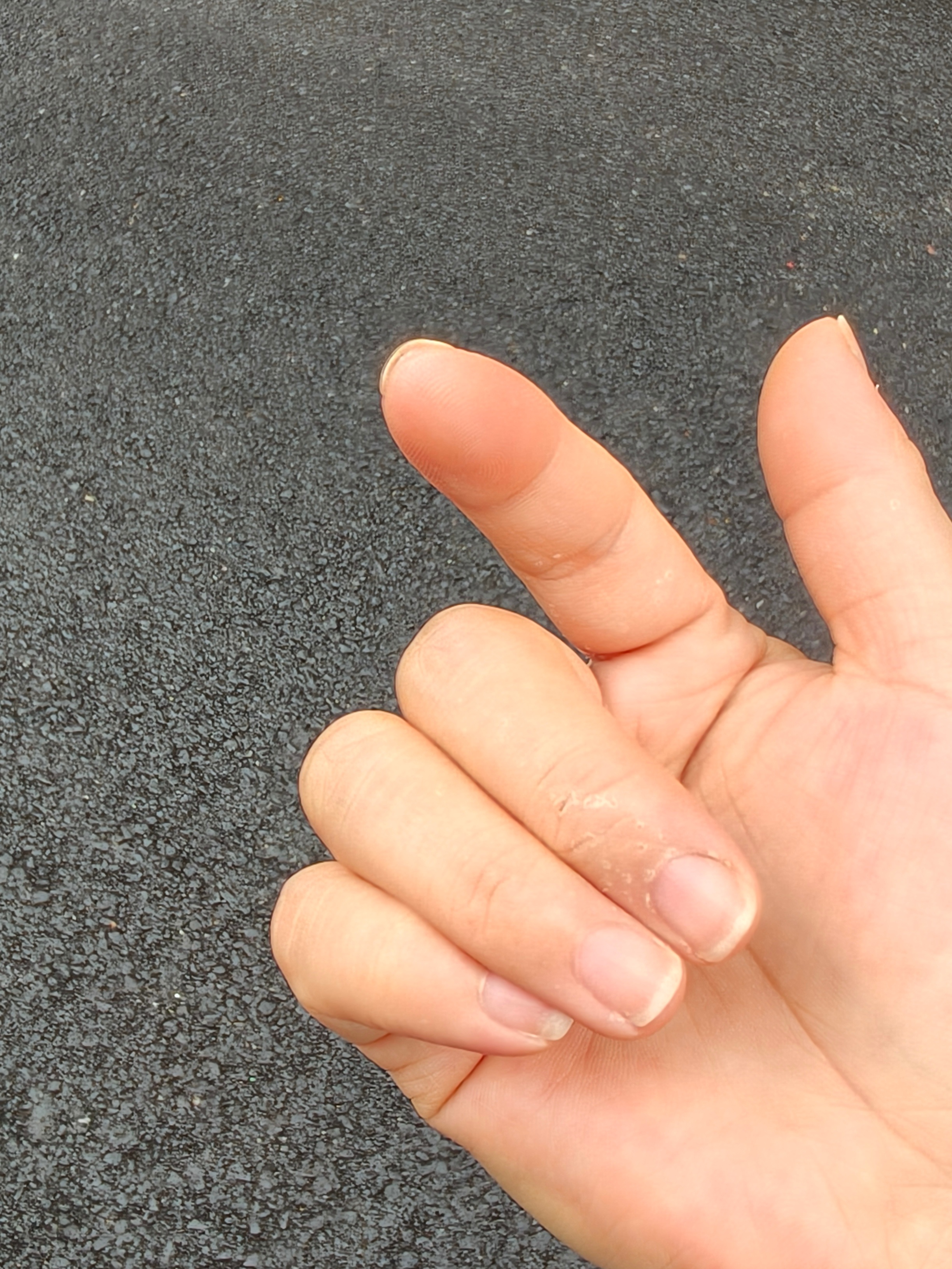 最近两个手指不知道干啥了前段时间长包，现在就脱皮 