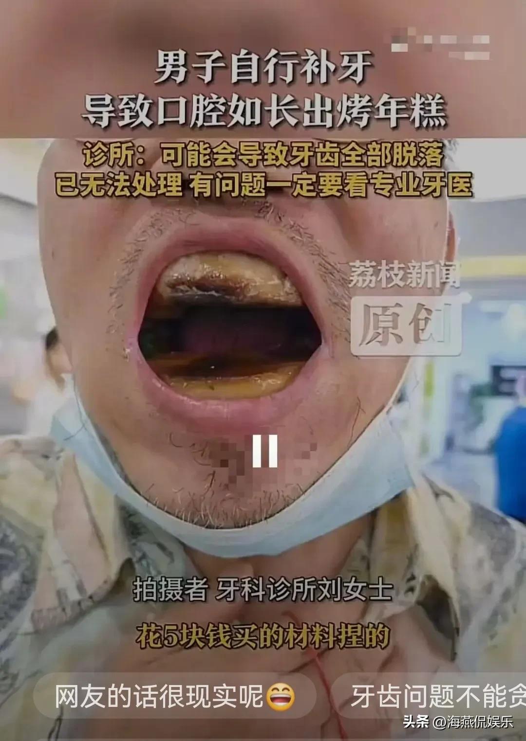 太心酸了！天津icon，大叔去口腔科看牙齿，嘴巴一张开把医生吓了一大跳，牙齿全部