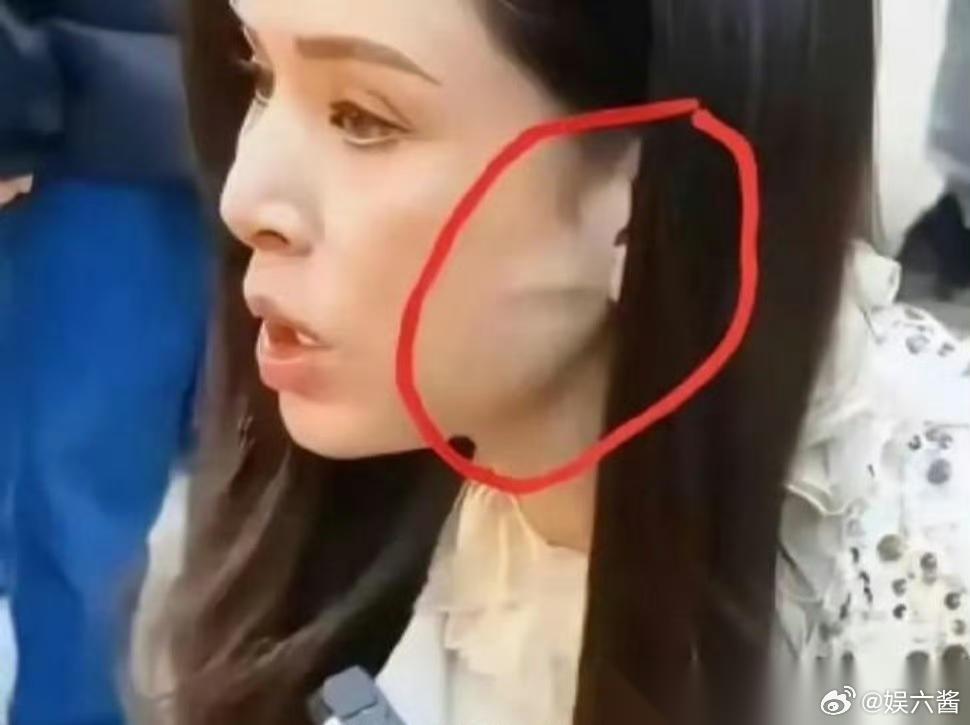 李若彤不是没有医美过吗？ 这耳前凸起的一条线是啥 ​​​ 年纪大了皮肤松弛？ ​